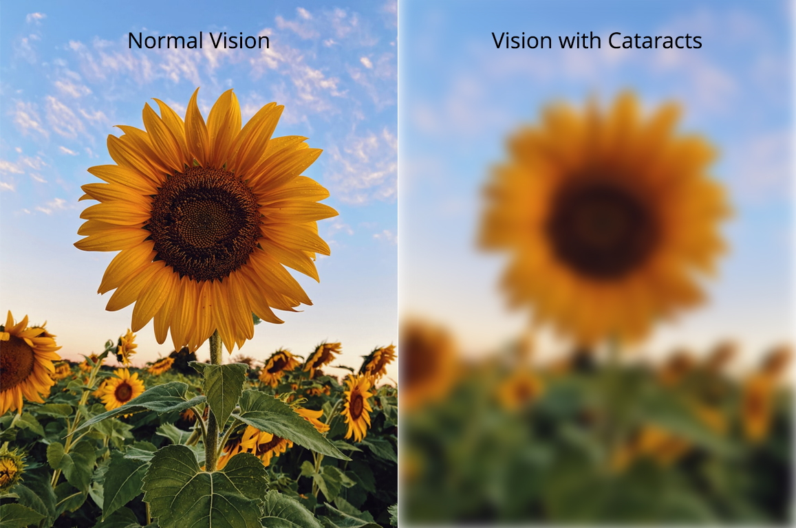 How Do I Know If I Have Cataracts Gulf Coast Vision Center how-do-i-know-if-i-have-cataracts-gulf-coast-vision-center